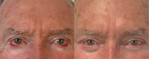 Reprise d'une blépharoplastie inférieure ratée avec ectropion dr Koppe lyon vienne regard