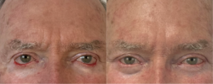cas complexe lifting malaire 