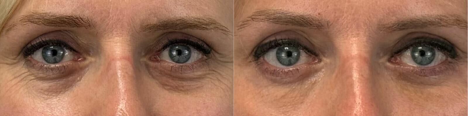 comparaison entre avant et après la chirurgie