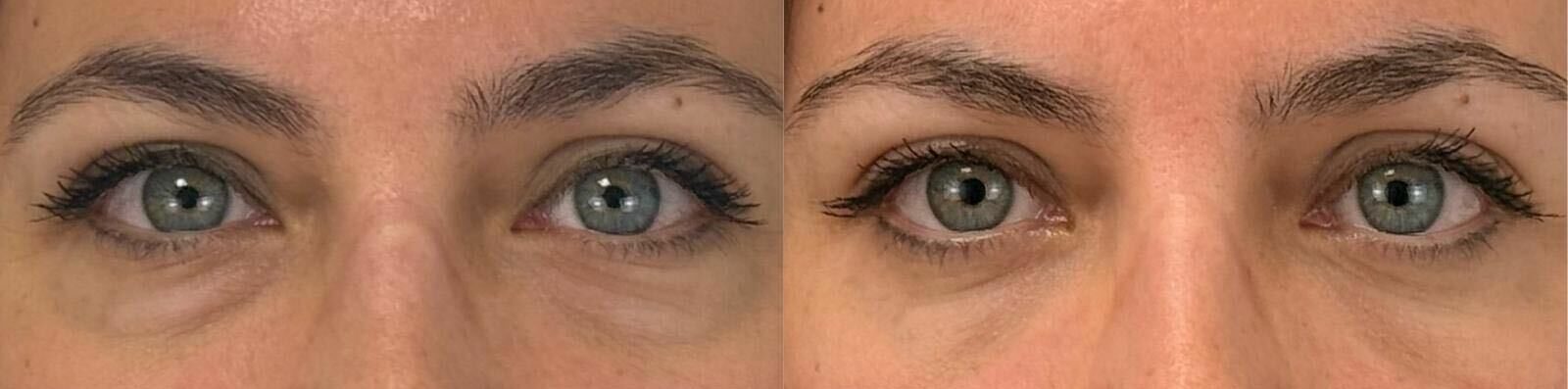 comparaison entre avant et après la chirurgie
