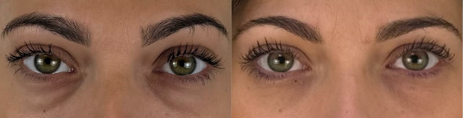 comparaison entre avant et après la chirurgie