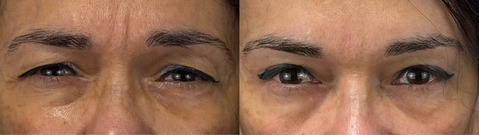 comparaison entre avant et après la chirurgie