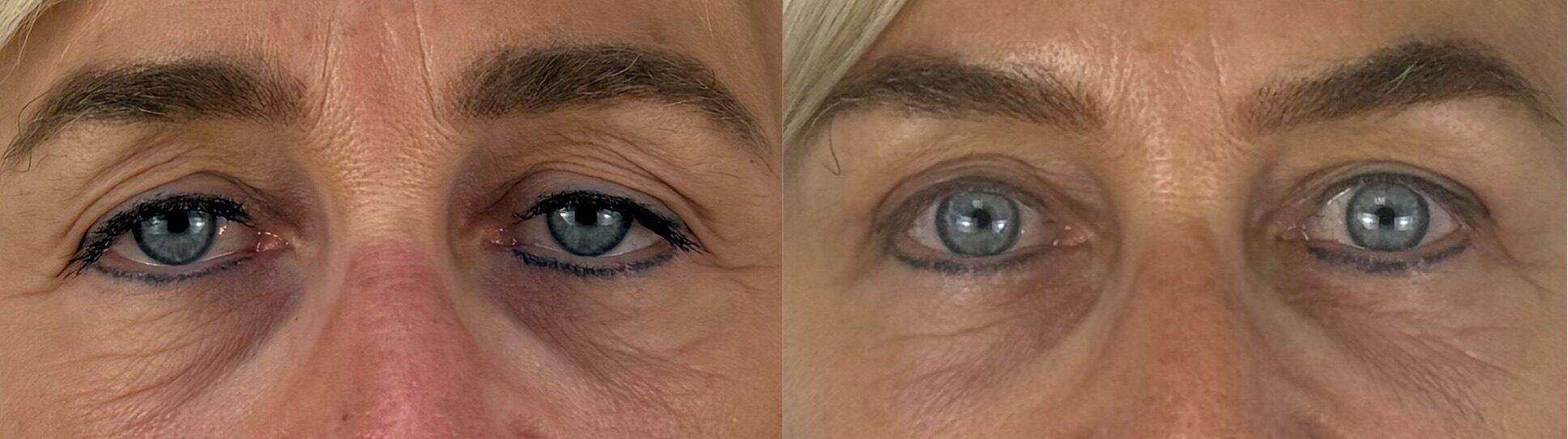 comparaison entre avant et après la chirurgie