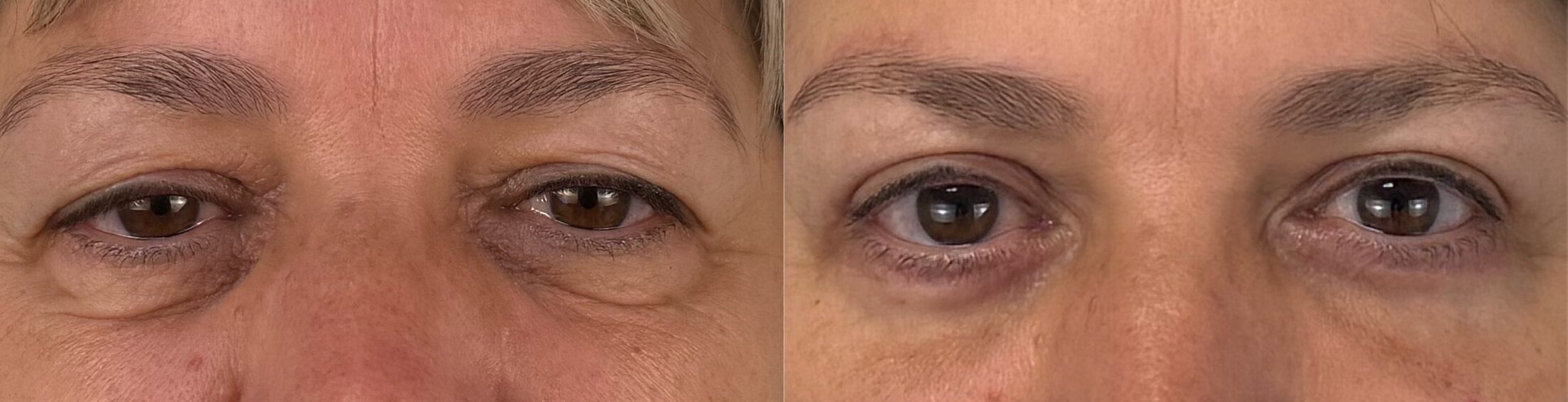 comparaison entre avant et après la chirurgie