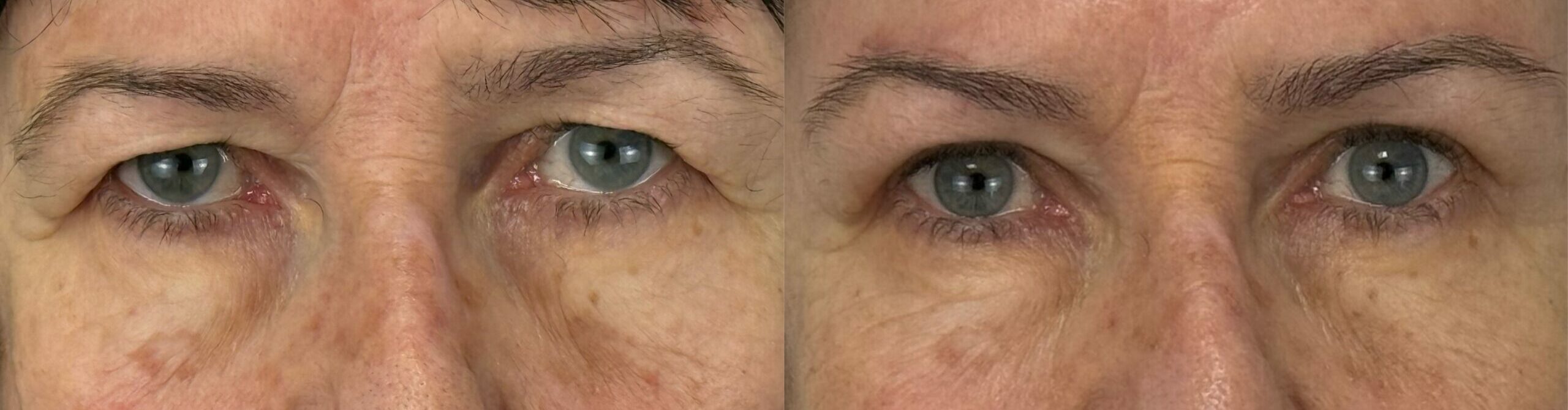 comparaison entre avant et après la chirurgie