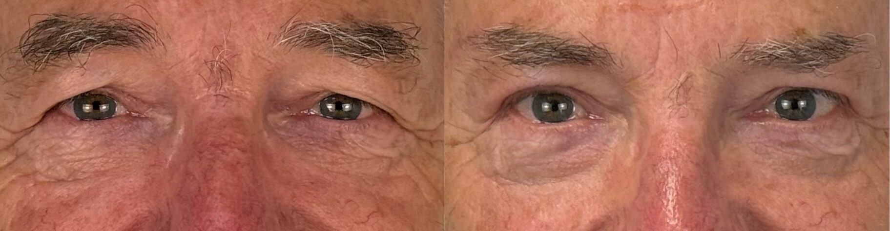 comparaison entre avant et après la chirurgie