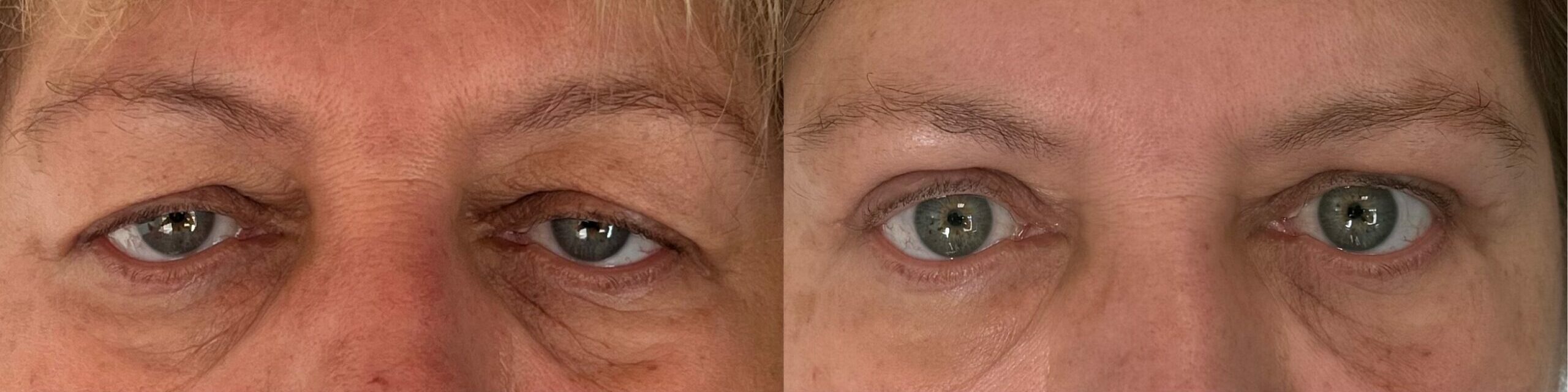 comparaison entre avant et après la chirurgie