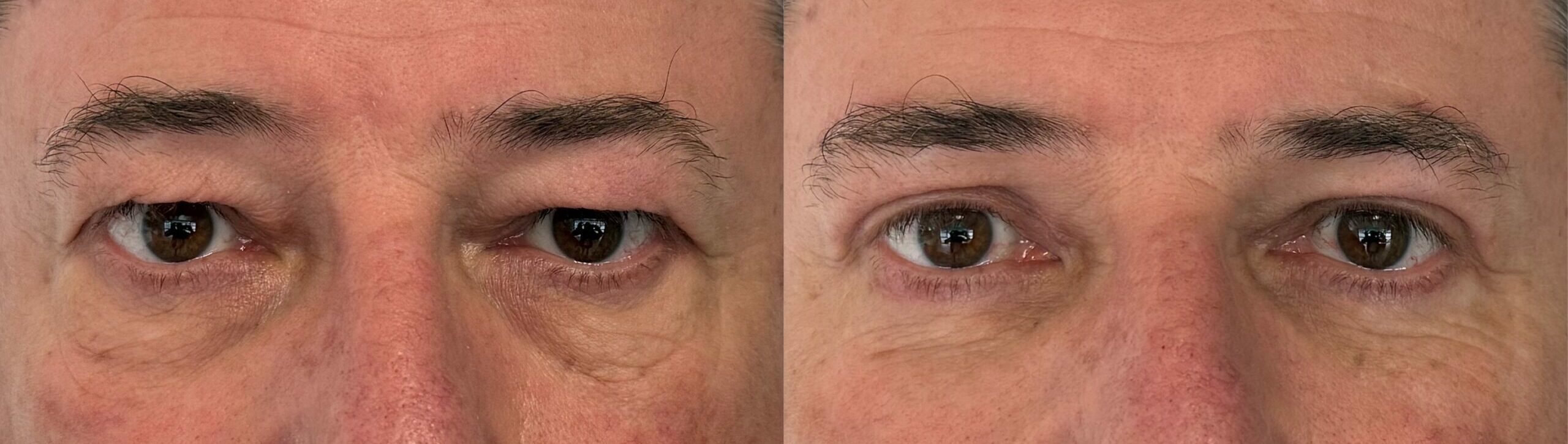 comparaison entre avant et après la chirurgie