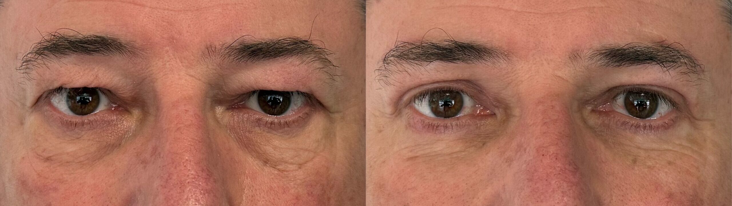 comparaison entre avant et après la chirurgie