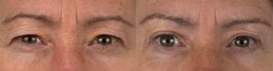Blépharoplastie supérieure Dr koppe