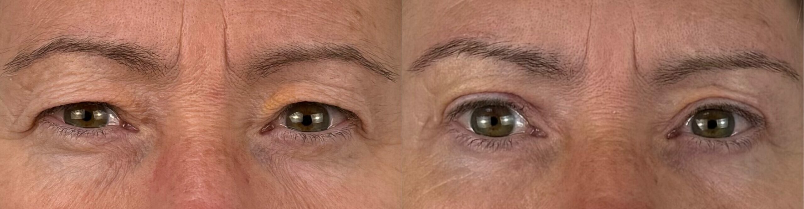 comparaison entre avant et après la chirurgie
