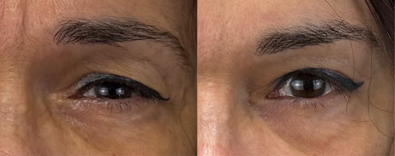 comparaison entre avant et après la chirurgie