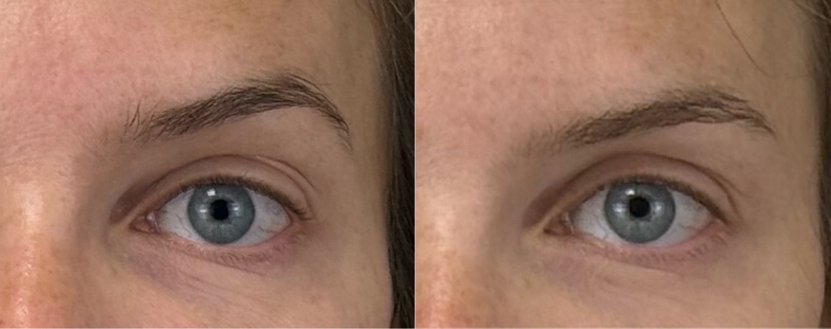 comparaison entre avant et après la chirurgie