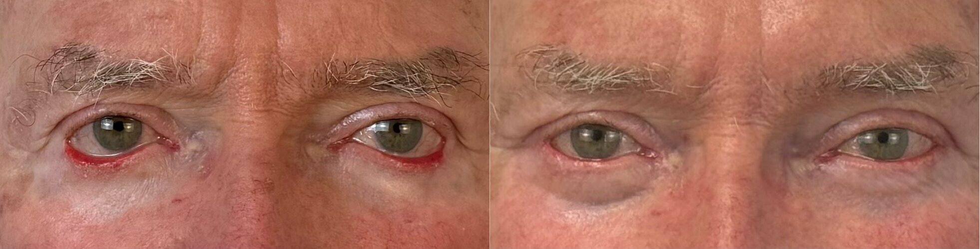 comparaison entre avant et après la chirurgie