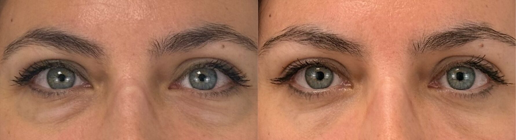 comparaison entre avant et après la chirurgie