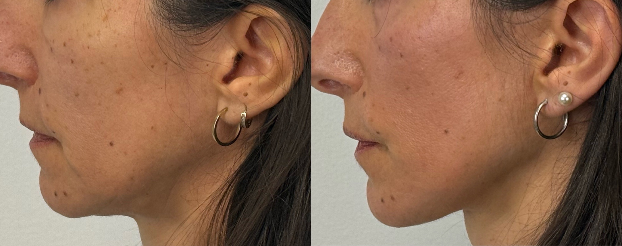 comparaison entre avant et après la chirurgie