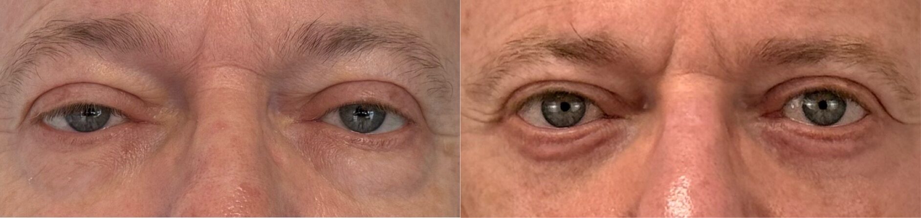comparaison entre avant et après la chirurgie