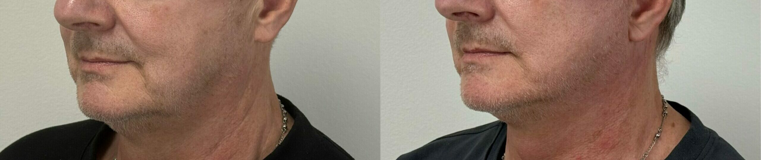 comparaison entre avant et après la chirurgie