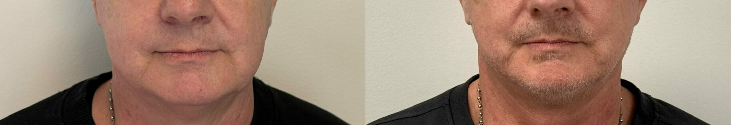 comparaison entre avant et après la chirurgie