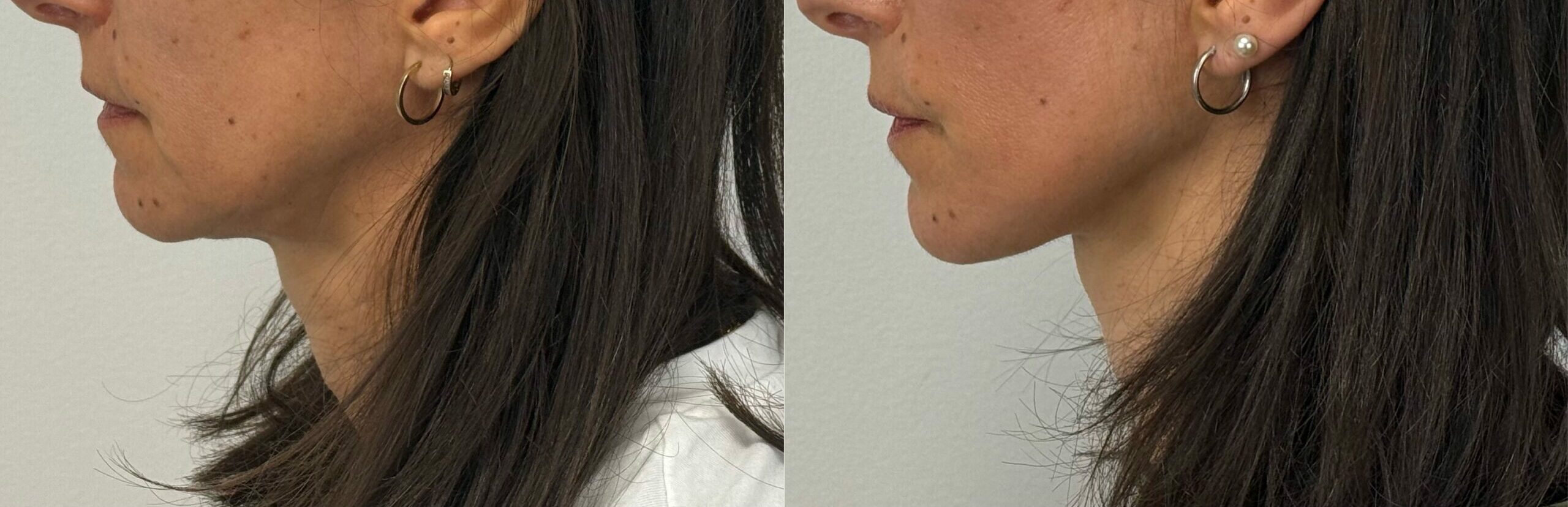comparaison entre avant et après la chirurgie