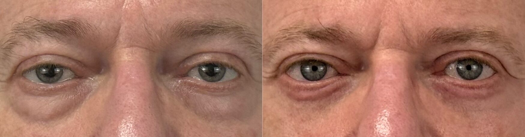 comparaison entre avant et après la chirurgie