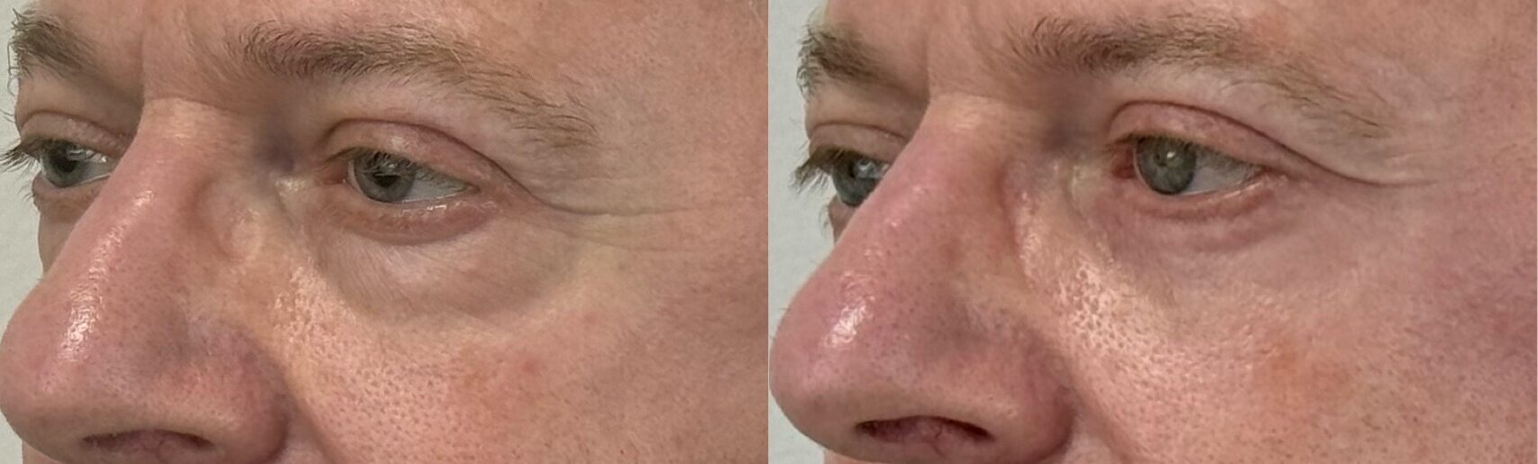comparaison entre avant et après la chirurgie