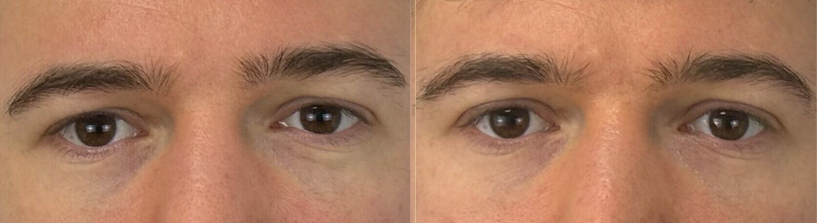 comparaison entre avant et après la chirurgie