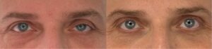 Ptosis bilatéral chirurgie du ptosis paupieres tombantes dr koppe 