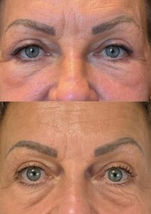 Avant après injections de hyaluronidase en vue d'une blépharoplastie - Dr Koppe 