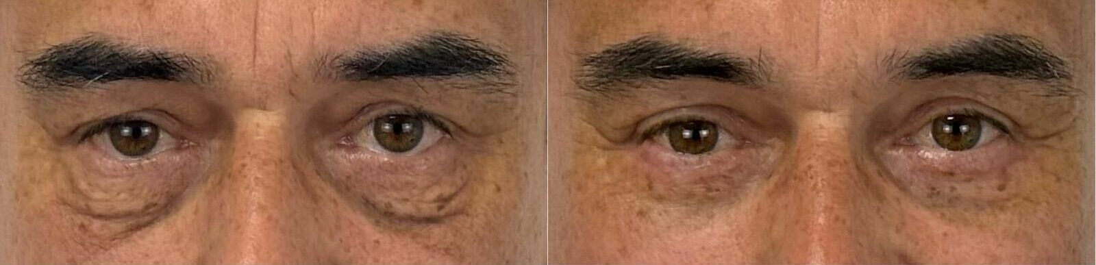 comparaison entre avant et après la chirurgie