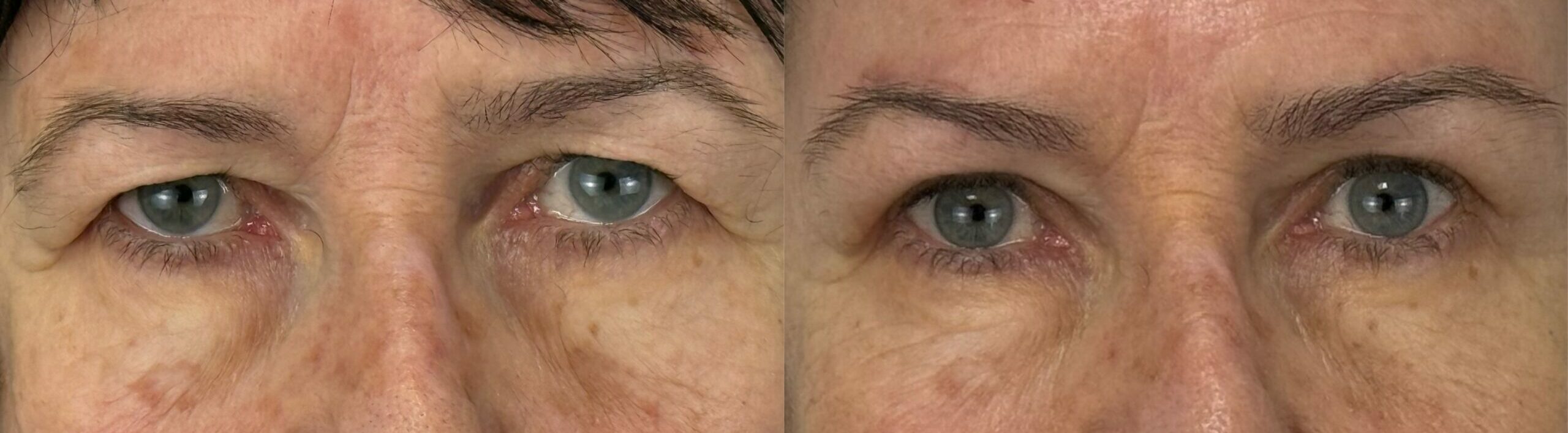comparaison entre avant et après la chirurgie