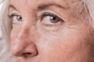 close up femme cerne peau relachee blepharoplastie medicale