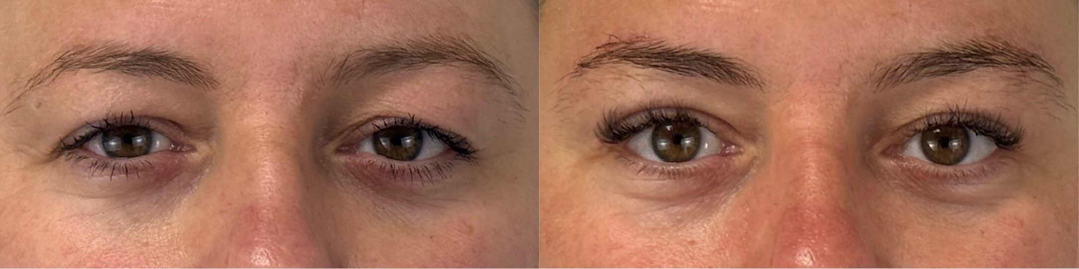 comparaison entre avant et après la chirurgie