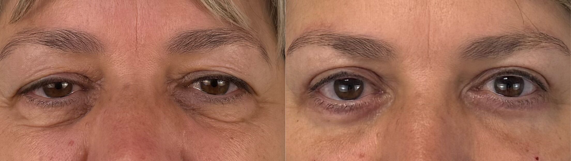 comparaison entre avant et après la chirurgie