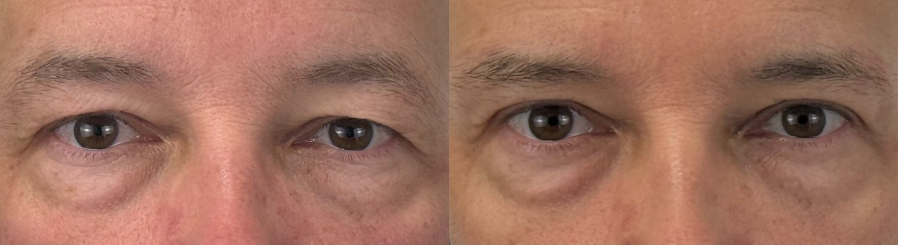 comparaison entre avant et après la chirurgie