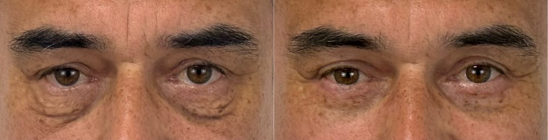 comparaison entre avant et après la chirurgie