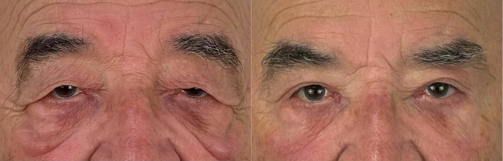 comparaison entre avant et après la chirurgie