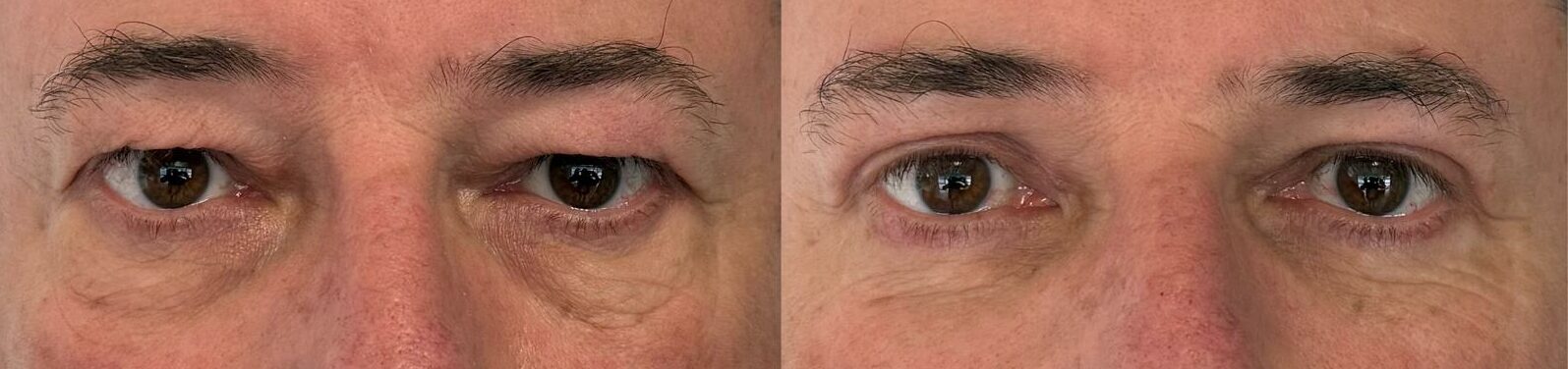 comparaison entre avant et après la chirurgie