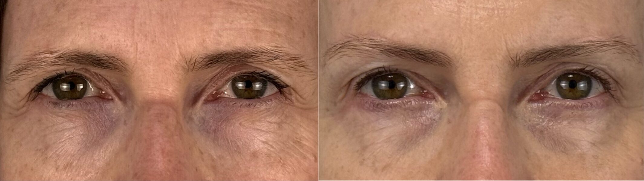 comparaison entre avant et après la chirurgie
