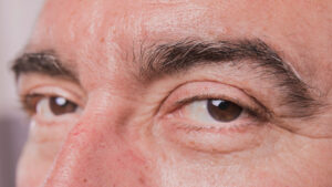 paupiere tombante asymetrique ptosis apres injections de botox toxine botulique dr koppe vienne lyon solutions