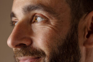 homme qui sourit avec rides et ridules autour des yeux blehpharoplastie laser 